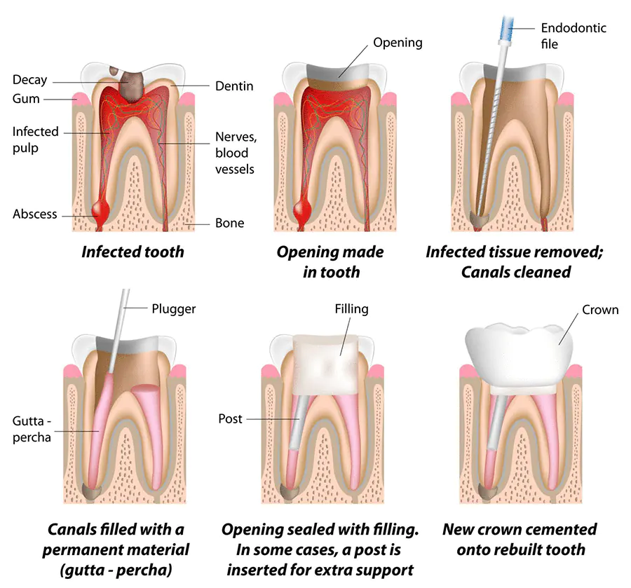 root-canal-annerley-brisbane