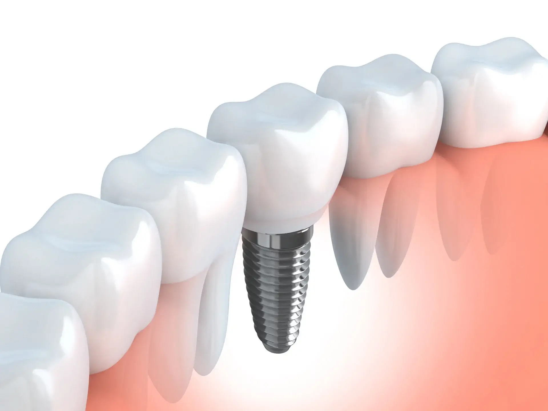 Dental Implant Service