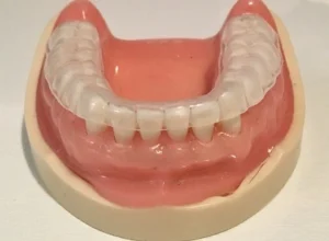 Custom Fitted Mouthguards Safeguard Teeth