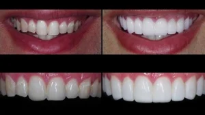 Porcelain vs Composite Resin Veneers