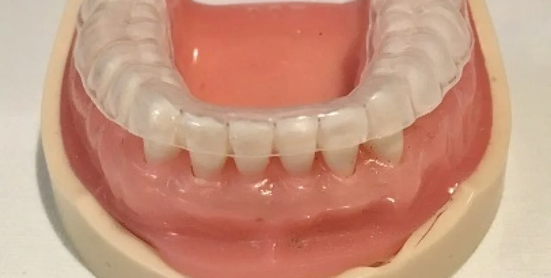 Custom Fitted Mouthguards Safeguard Teeth