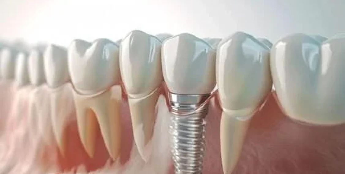 Dental Implant