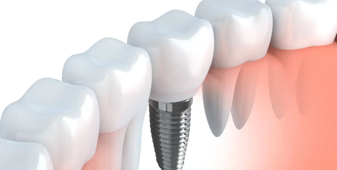 Dental Implant Service