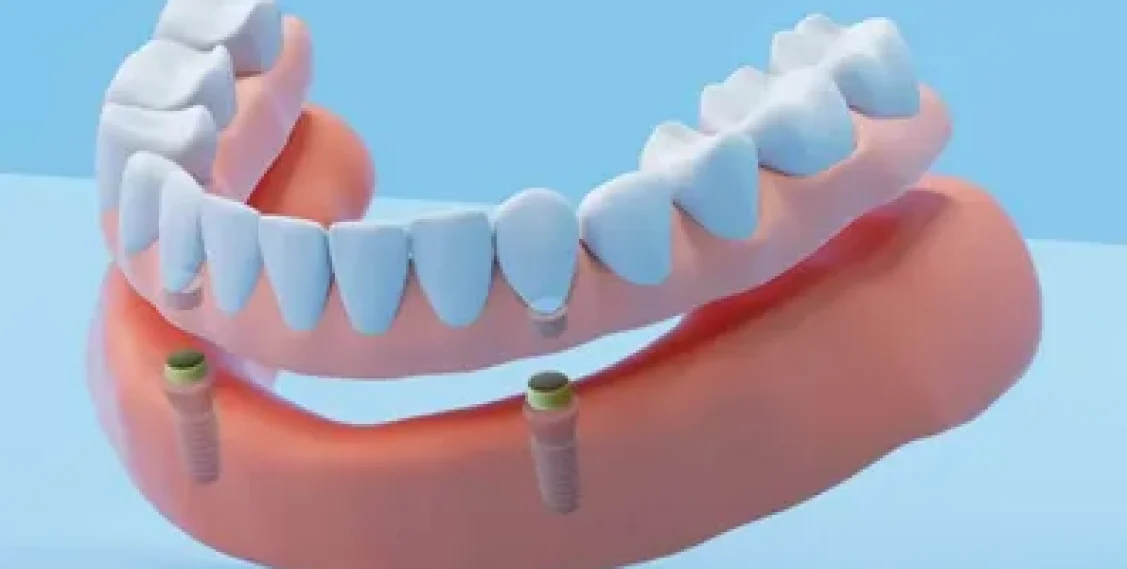Dentures vs Implants