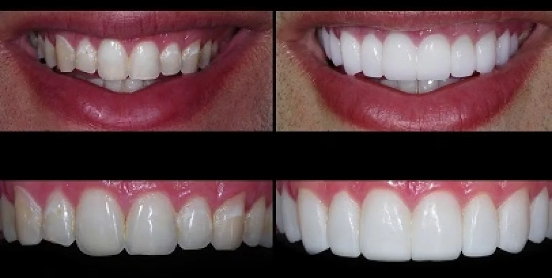 Porcelain vs Composite Resin Veneers