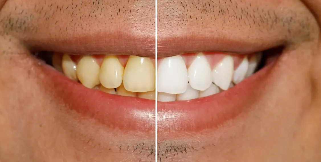 Teeth Whitening Services