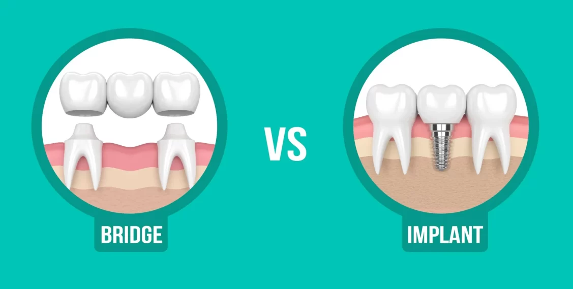 Tooth Implant vs Dental Bridge
