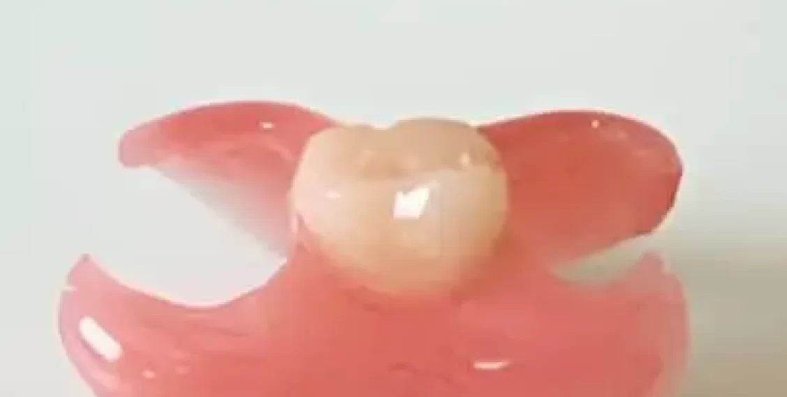 Vaplast unilateral one tooth denture