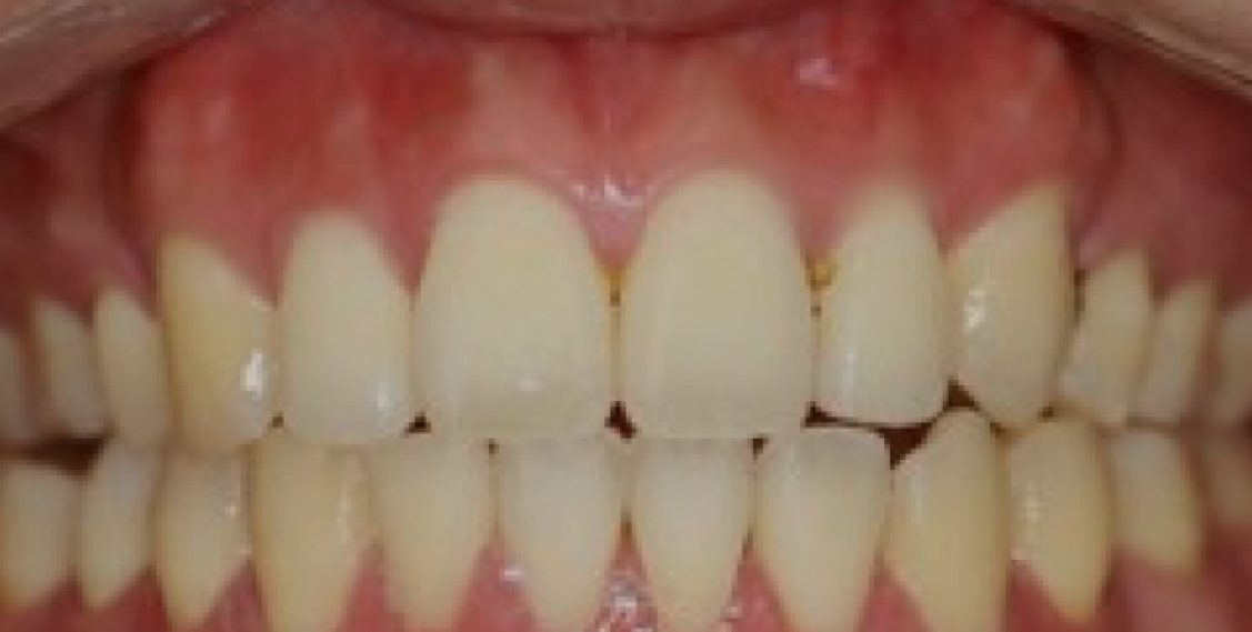 Braces