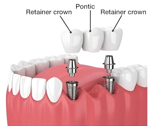 cantilever dental bridge