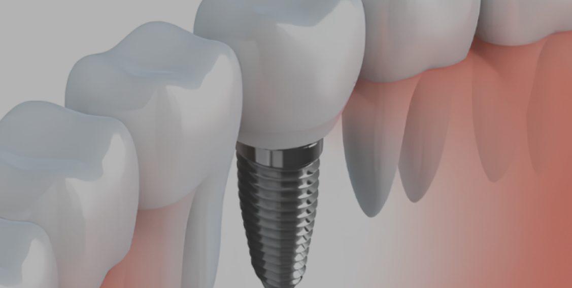 dental implants
