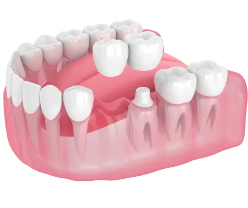 implant-supported bridge