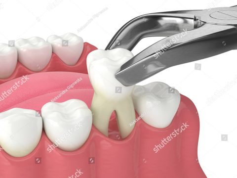 stock-photo - d-render-of-lower-jaw-with-tooth-extracted-by-dental-forceps-1833794608 (1)