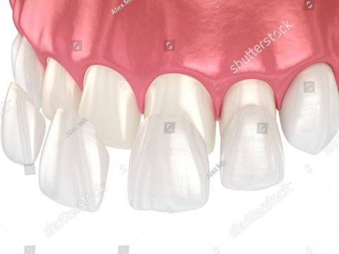 stock-photo-dental-veneer-placement-over-frontal-teeth-d-illustration-2387734037 stock-photo-dental-veneer-placement-over-frontal-teeth-d-illustration-2387734037
