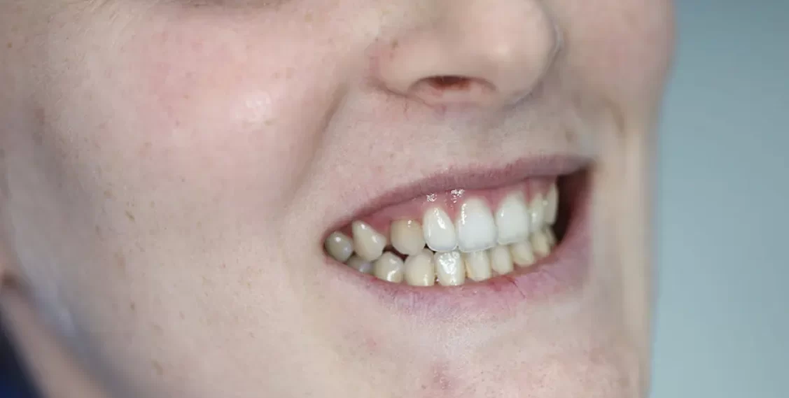 stop-sensitive-teeth-pain-immediately